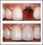 Single-Tooth Implant Restoration